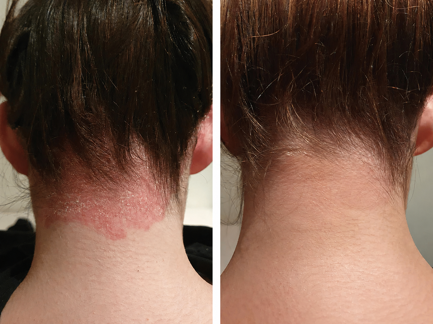 Go Psoriasis
