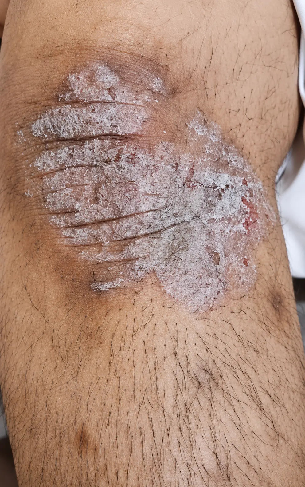 Go Psoriasis Organic Cream applied to skin