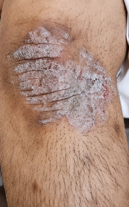 Go Psoriasis Organic Cream applied to skin