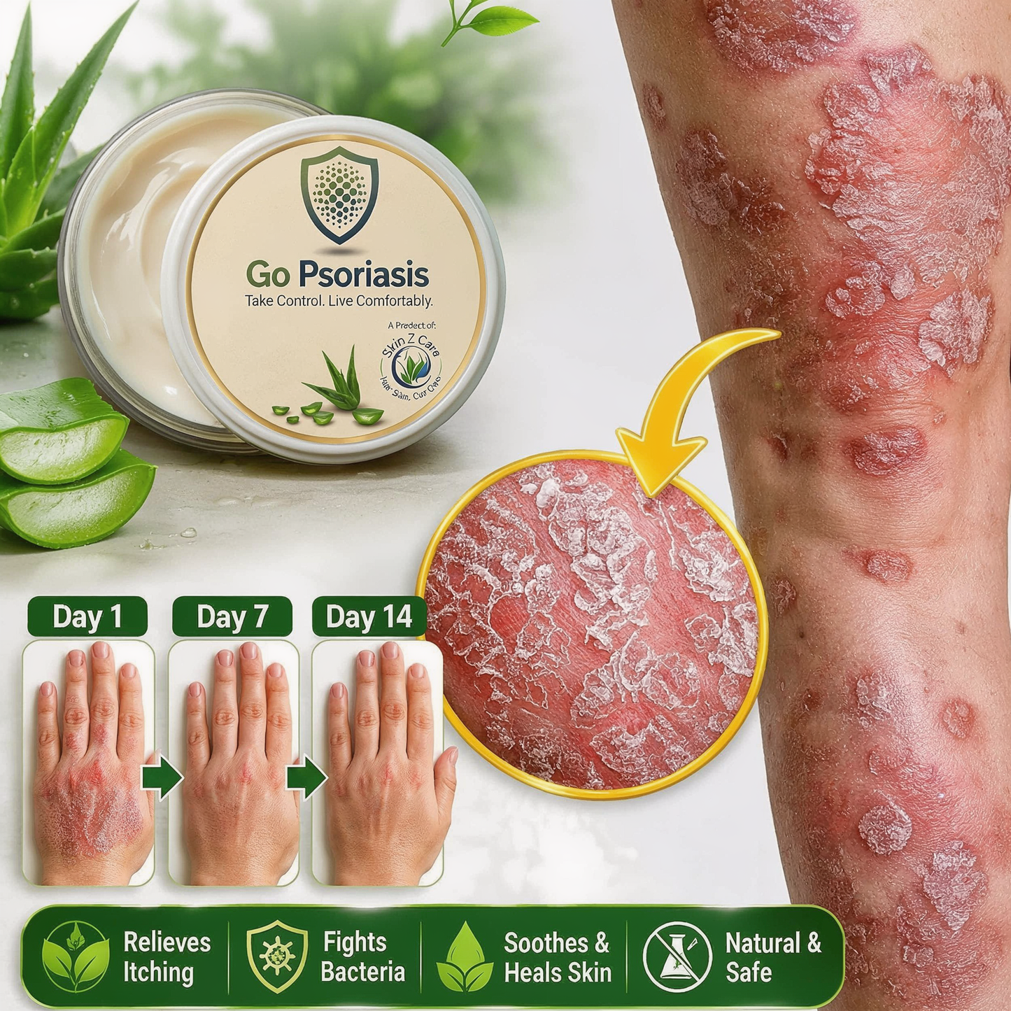 Go Psoriasis