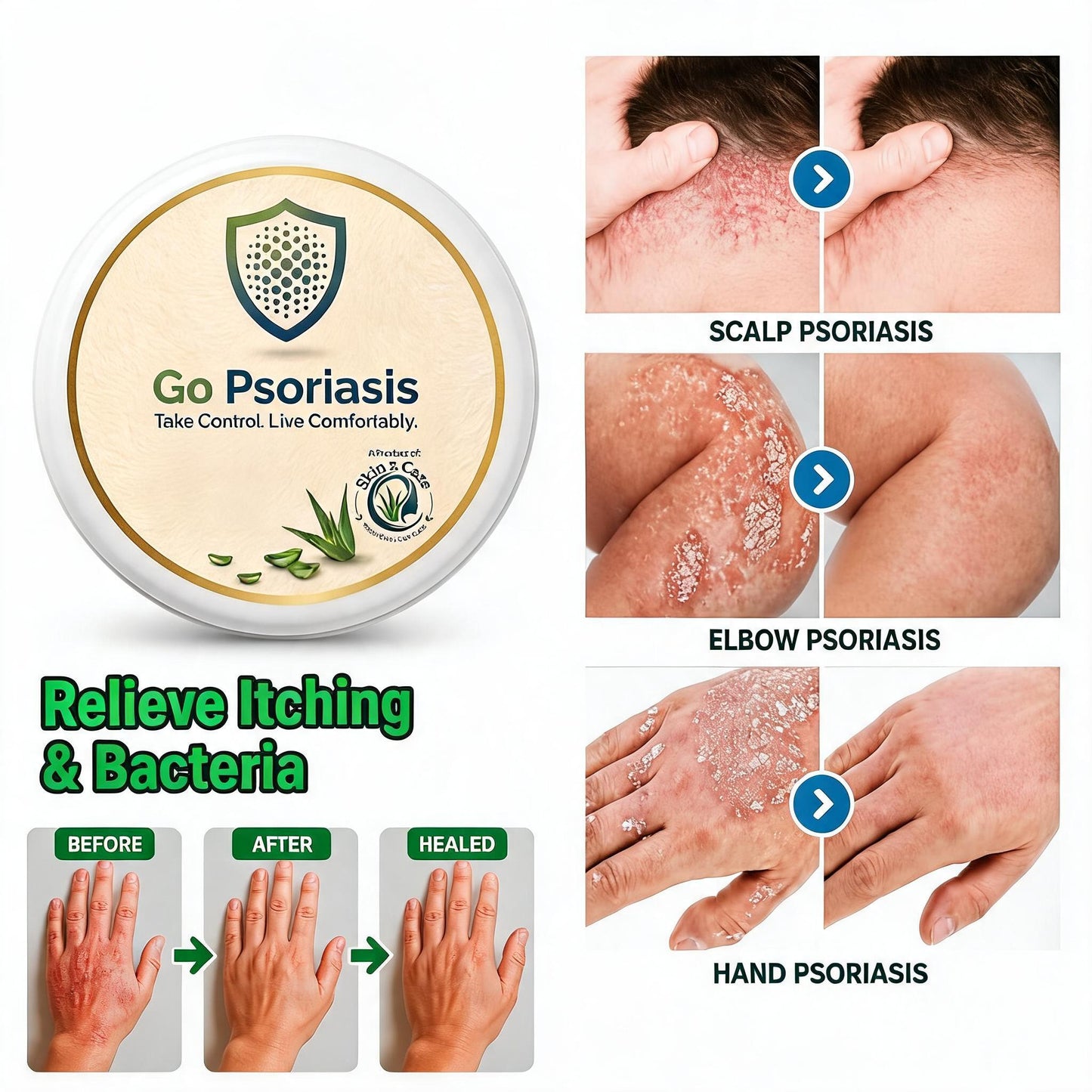 Go Psoriasis